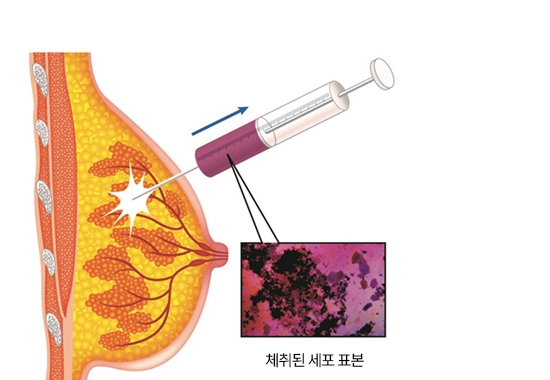 미세침흡인 세포검사