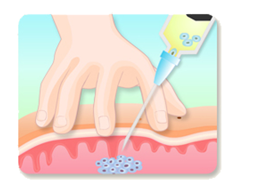 세포 채취 방법1