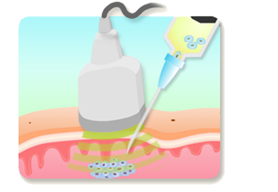 세포 채취 방법2