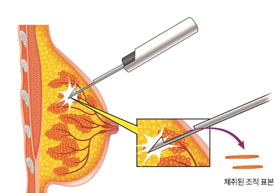중심생검 조직검사