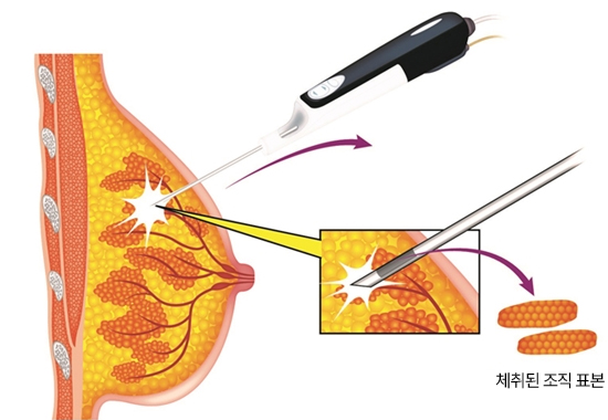 진공흡인 조직검사