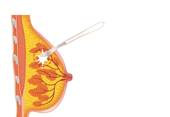 절개/절제 생검