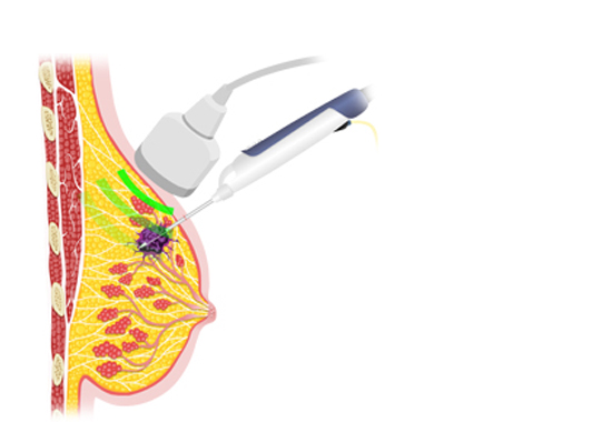 맘모톰 시술과정