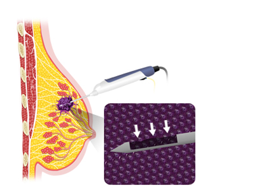 맘모톰 시술과정
