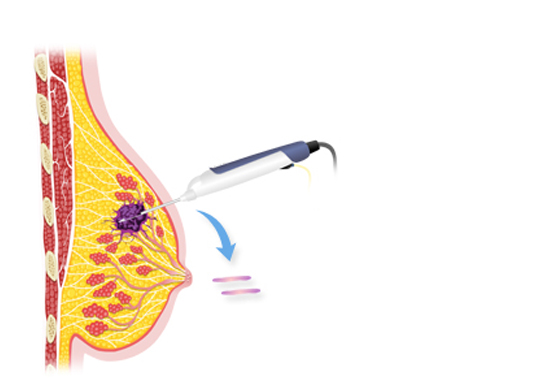 맘모톰 시술과정