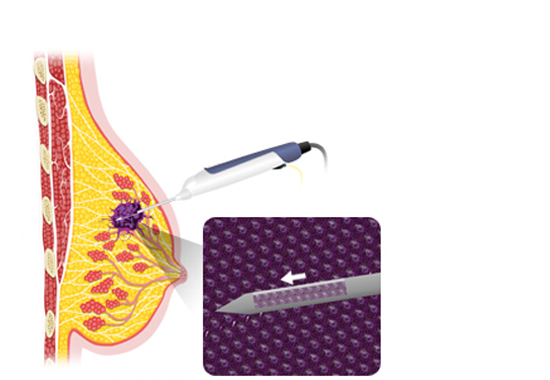 맘모톰 시술과정