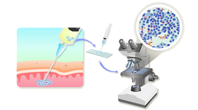 미세침흡인 세포검사